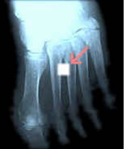 Feet X-rays 